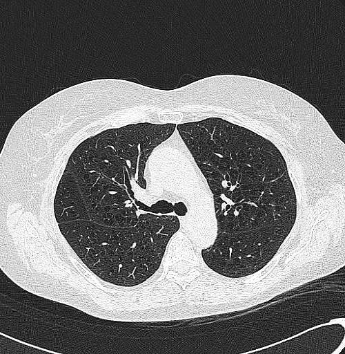 EFEITOS ADVERSOS DOS CORTICOIDES INALAT�RIOS NA DPOC: METAN�LISE
